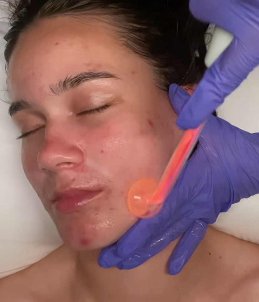Acne Enzyme Facial