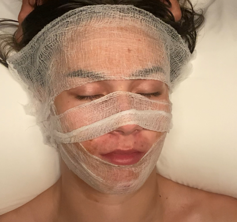 Acne Enzyme Facial
