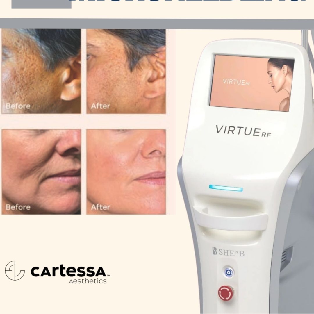 Virtue RF Microneedling Face 3 at The Skin Bar & Med Spa in Bryant, AR
