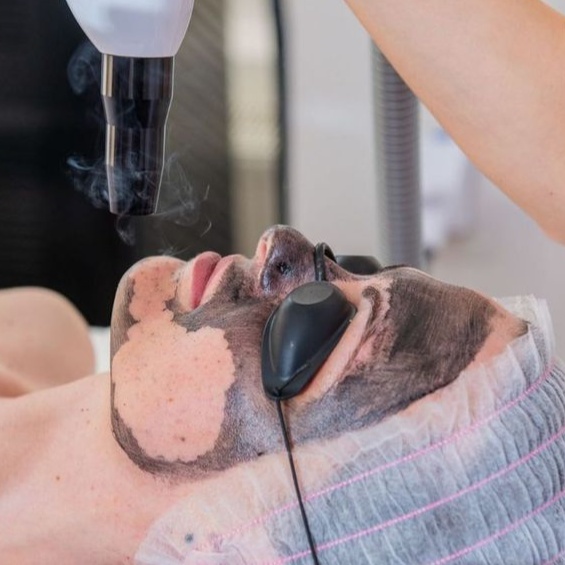 HOLLYWOOD PEEL FACIAL at GOLD SKIN SPA AND BEAUTY in MCALLENT, TX