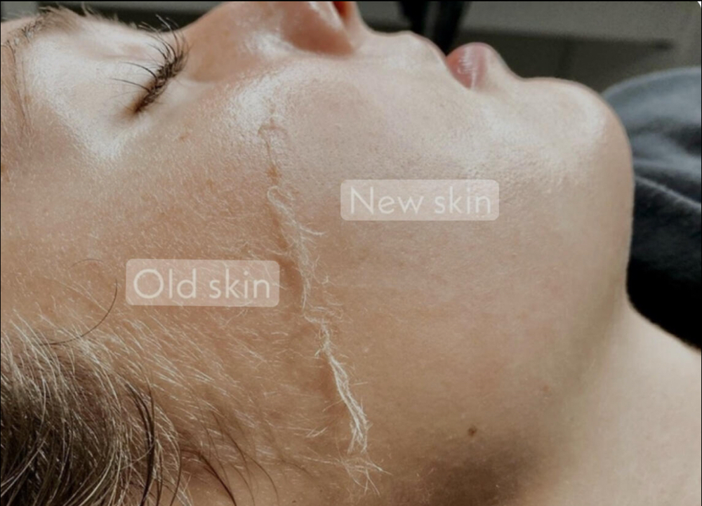 Dermaplane Treatment