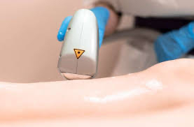 Laser Varicose Vein Removal (3)