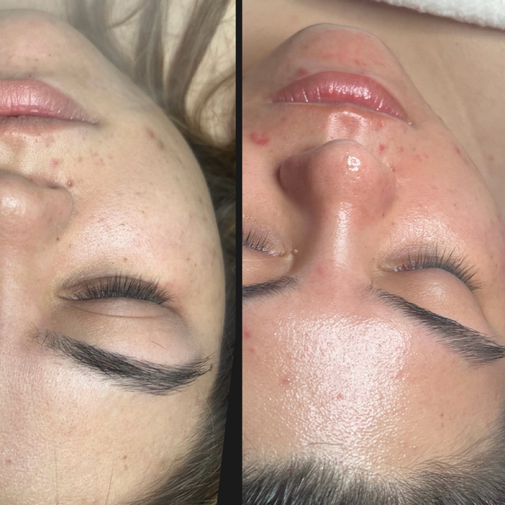 Hydraglow Facial at Kohinoor Aesthetics By Marissa Elizabeth in San Antonio, TX