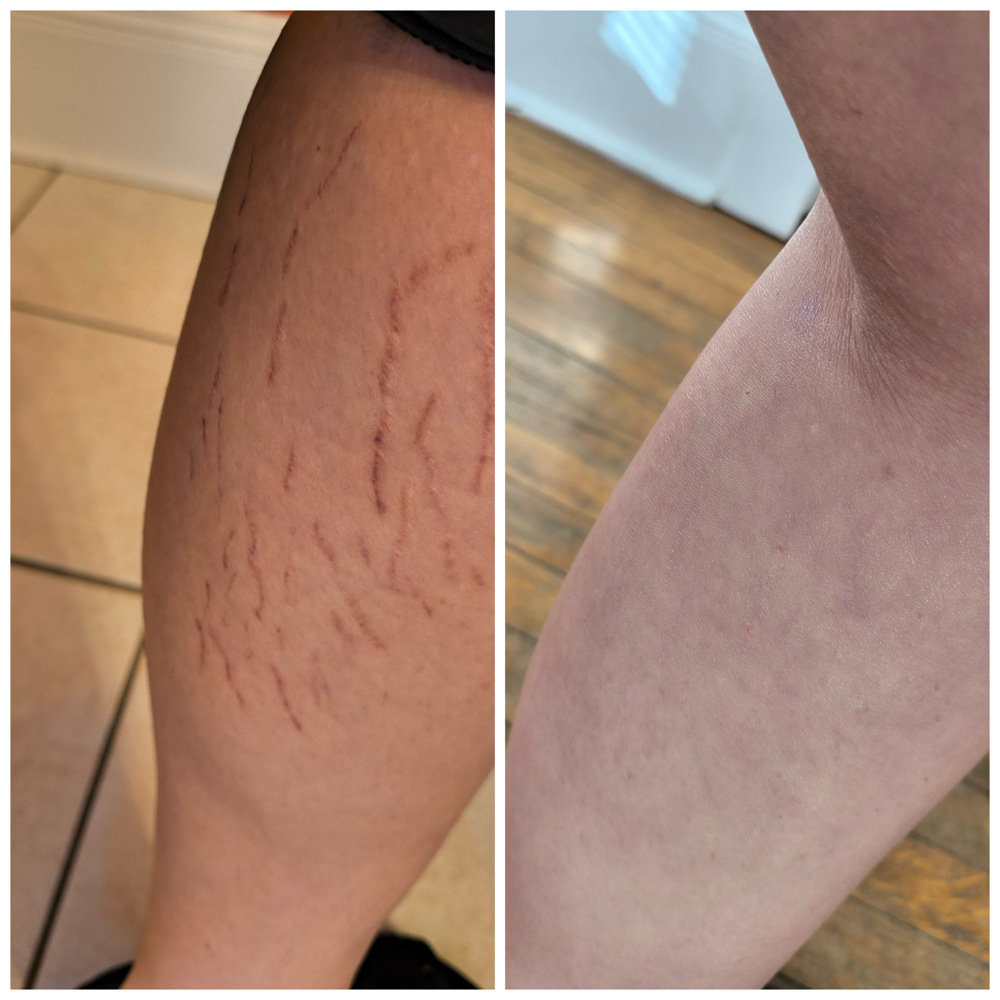 Stretch Mark Inkless revision