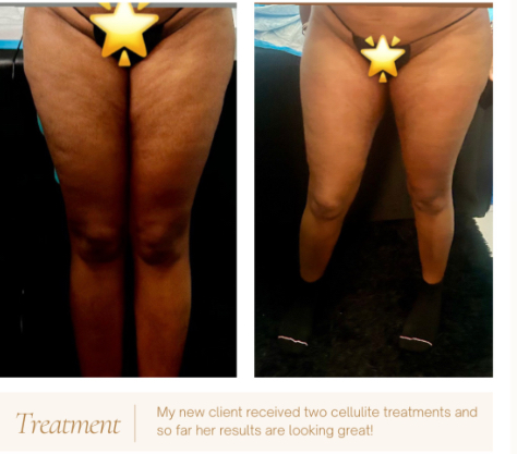 SINGLE CELLULITE SMOOTH-OUT SESSION at ShapedbyNicolabrowsandbody in Brooklyn, NY
