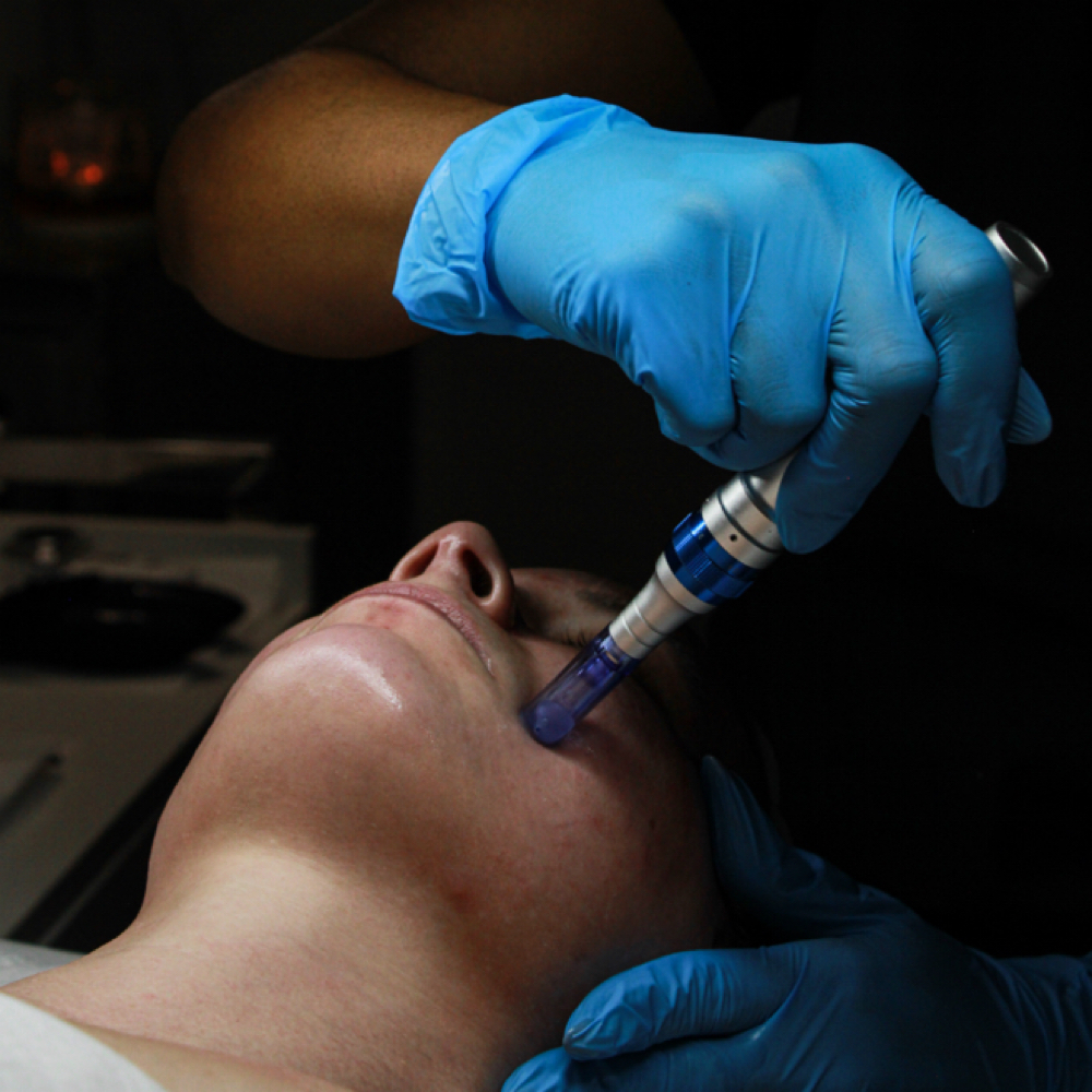 PURE | VEGAN MICRONEEDLING at Advanced Esthetics Dallas Acne Clinic in Richardson, TX