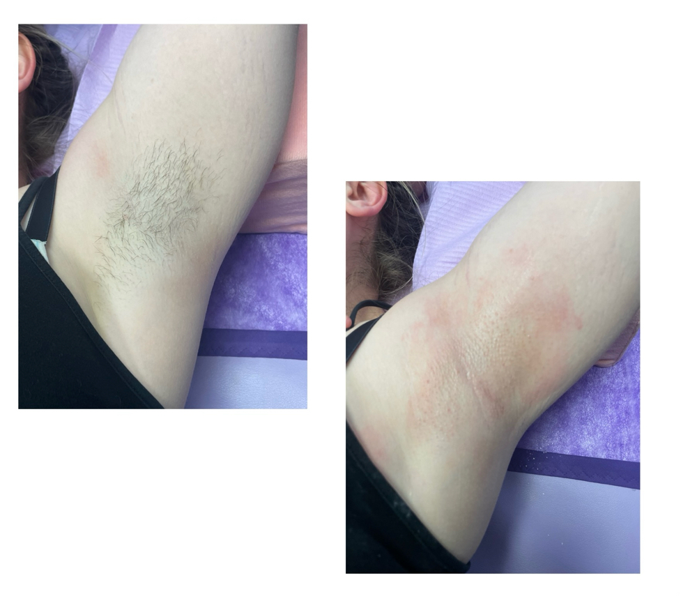 Underarm Wax