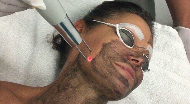 Hollywood Facial-Carbon Laser Peel