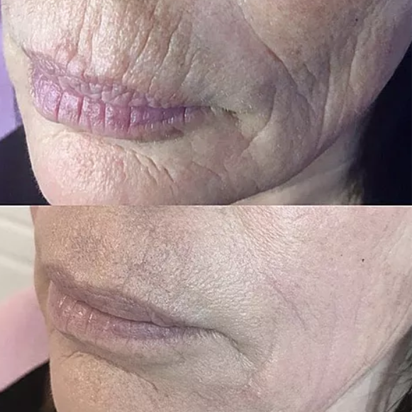 Fibroblast Treatment (Lip lines) at Luscious Tox Aesthetics in Arlington, TX