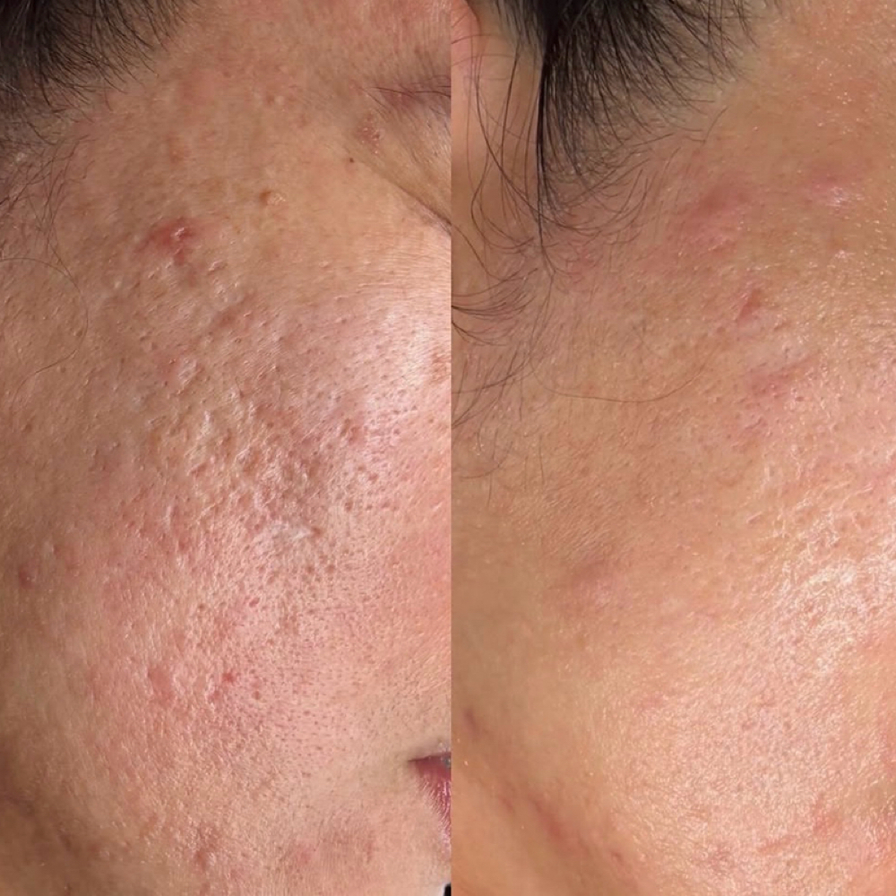 Acne Scars at Sanazskincenter in Vienna, VA