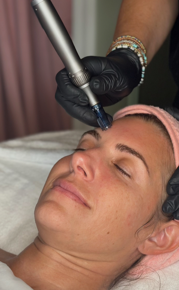 Microneedling