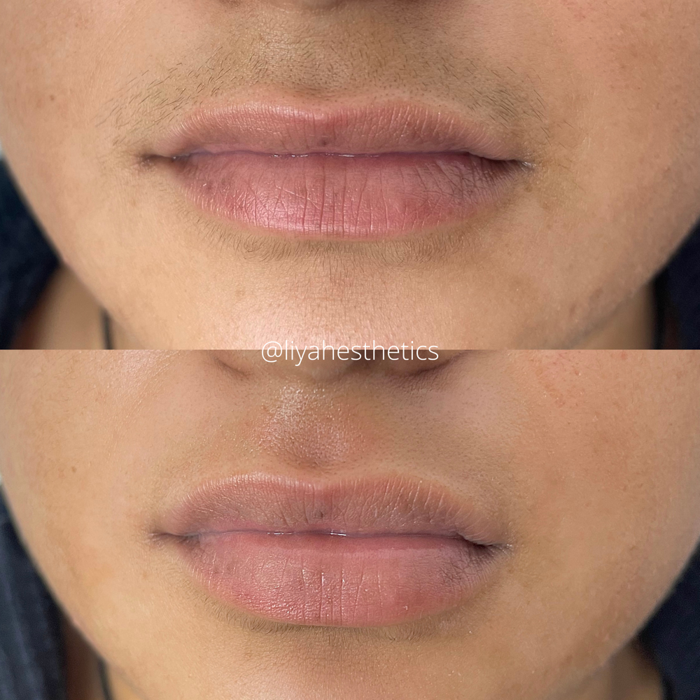 Lip/Chin