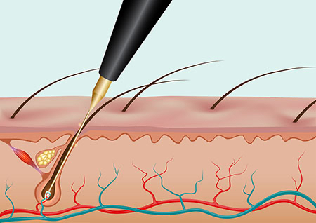 Electrolysis 15 Minutes