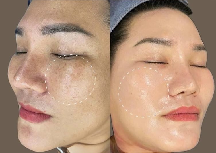 Face - Dark Skin - Plasma Fibro
