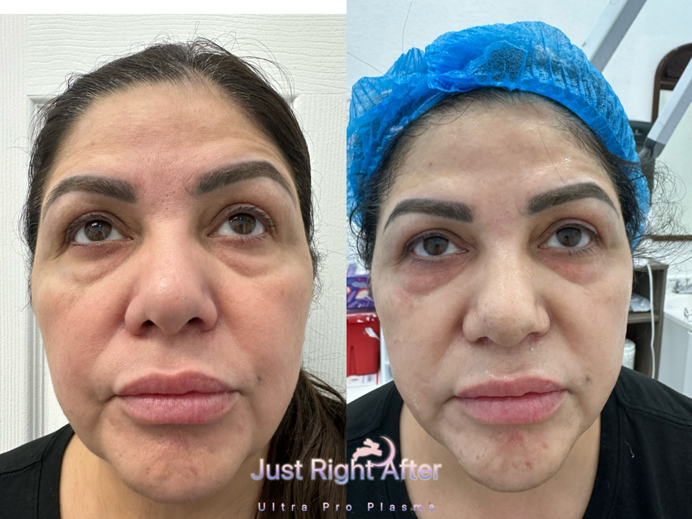 Full Face Warm ColdPlasma Treatment