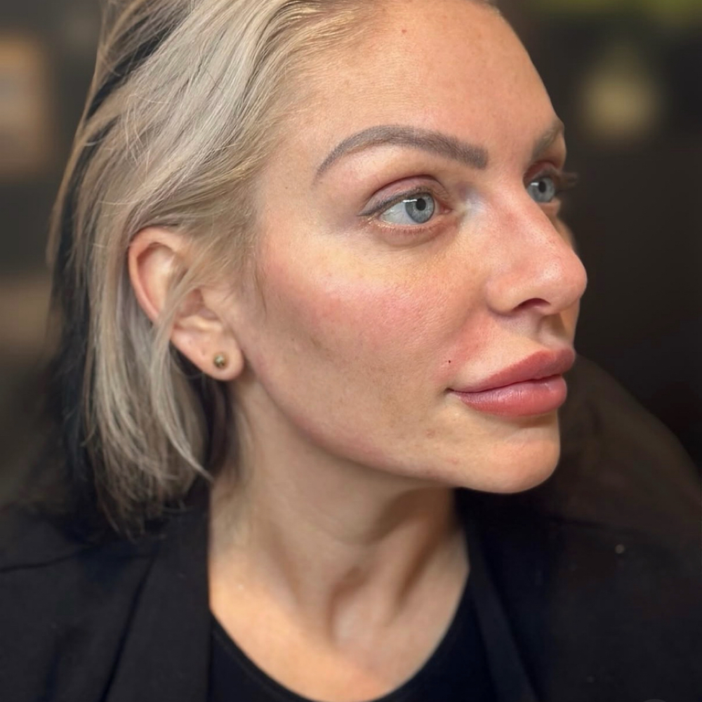 Jaw Filler at Etch Aesthetics in rochester, NY