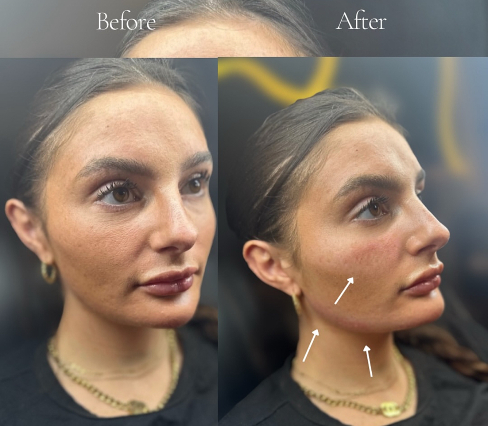 Jaw Filler