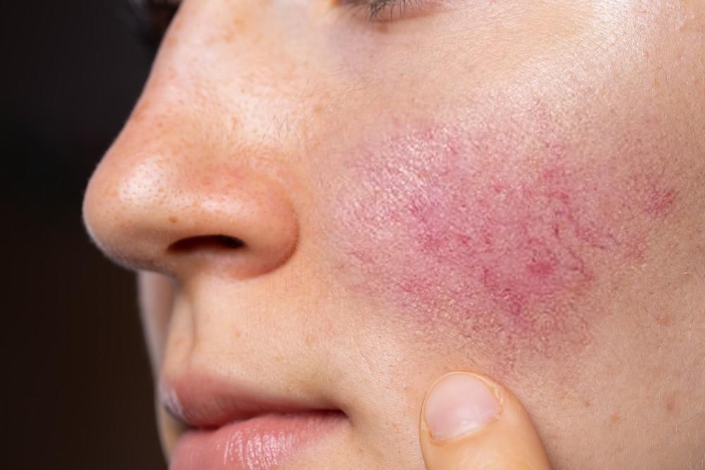 Rosacea Rescue Facial