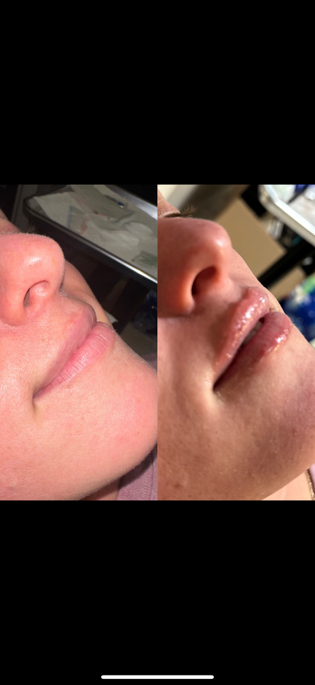 1 ml - New Clients
