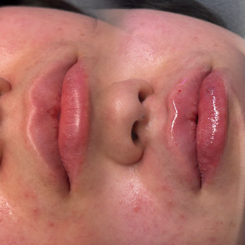 April Sale 2ML lip Filler