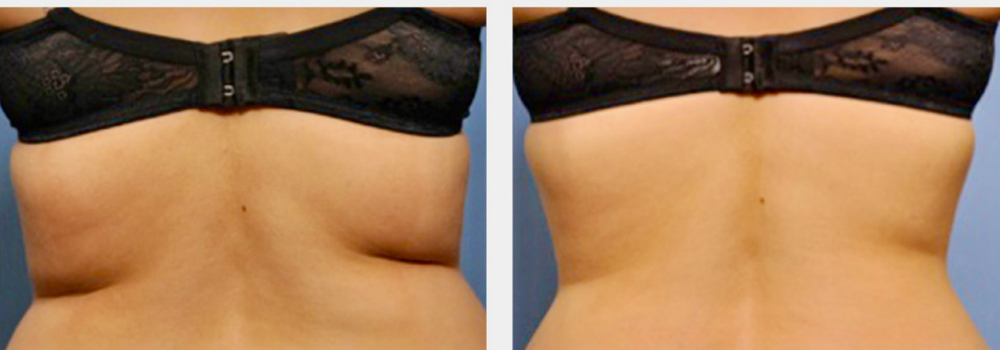 Exilis  On Back /Bra Fat Pkg Of 6