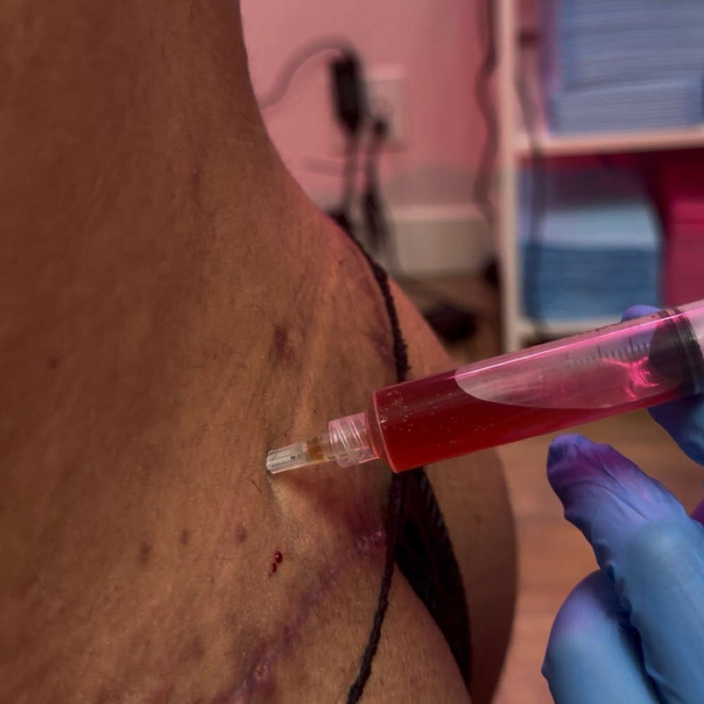 Seroma Drainage at Lymphatic Post-Op Spa in San Diego, CA
