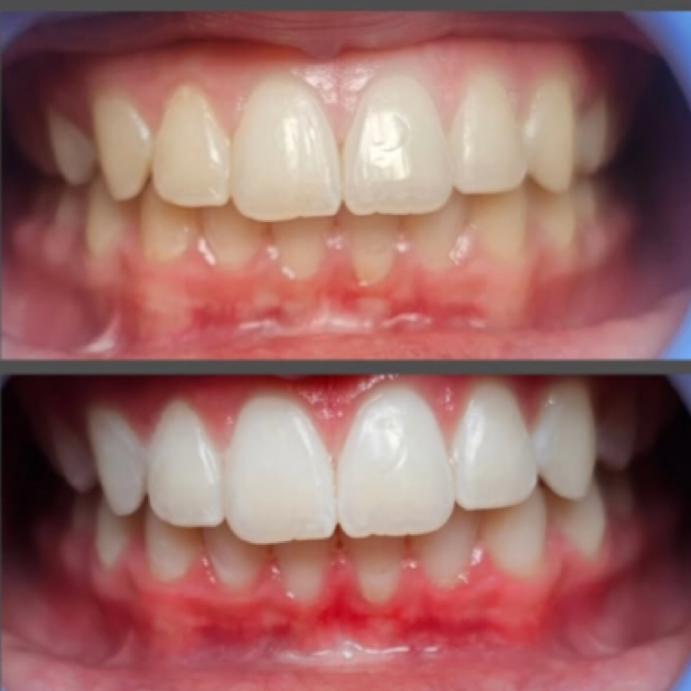 Bronze & Bright – spray tan + teeth at The Vivid Glow in Cameron Park, CA