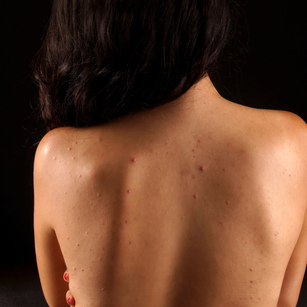 Back Acne Treatment