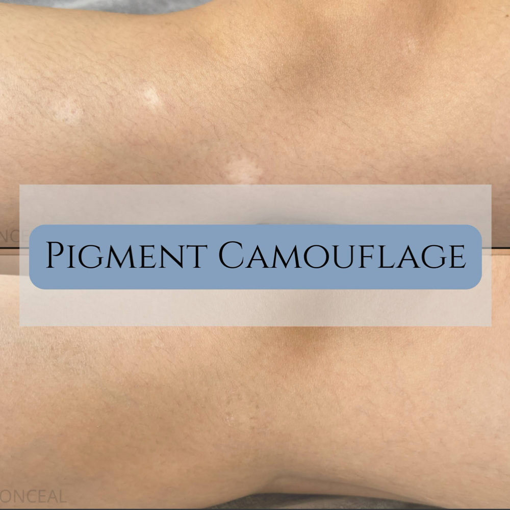 Pigment Camouflage at Carolina Restorative Aesthetics in Greer, SC