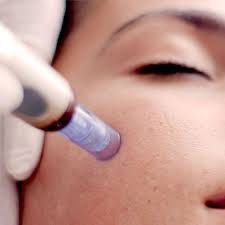 Micro-Needling