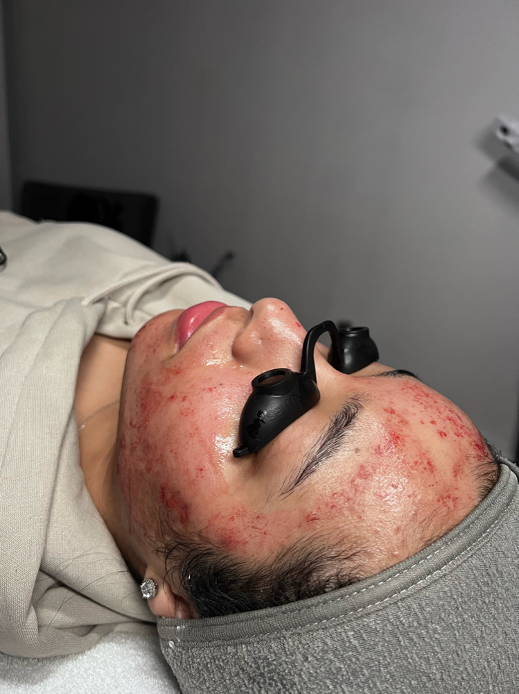 Microneedling at Sweet Touch Skin in Manassas, VA