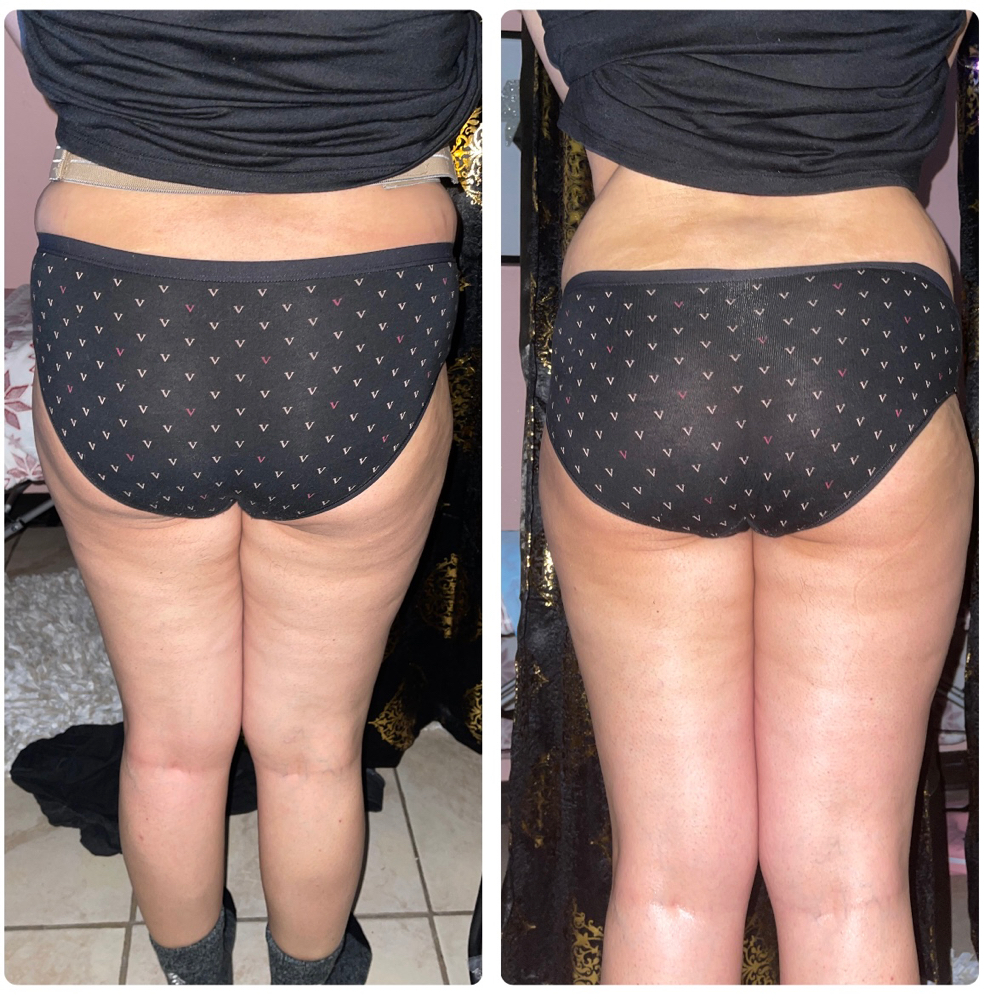 Vacuum Buttlift/ Levanta Gluteos