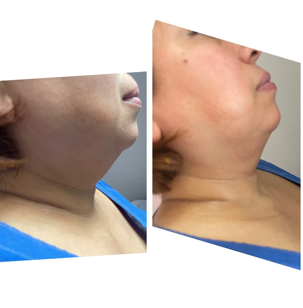Chin Lipo/ Lipo papada