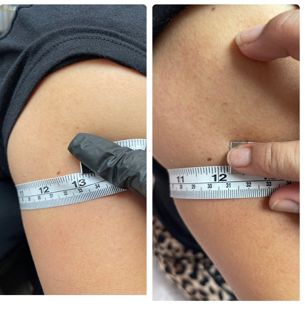 Arm Lipo