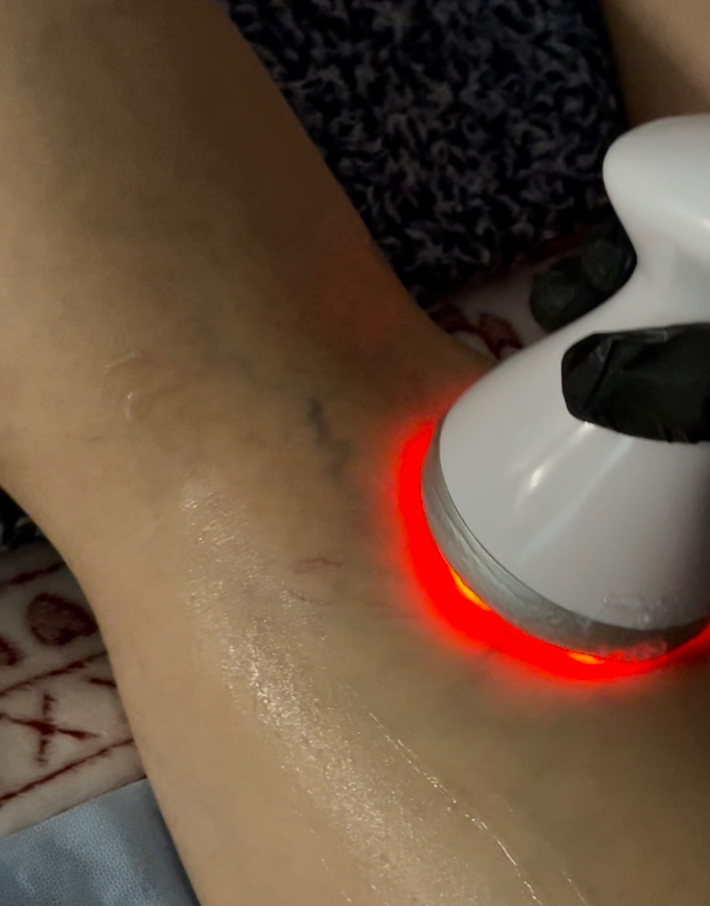 Cellulite / Varicose Veins
