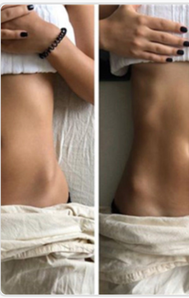 Cavitation Lipo Add On Zone