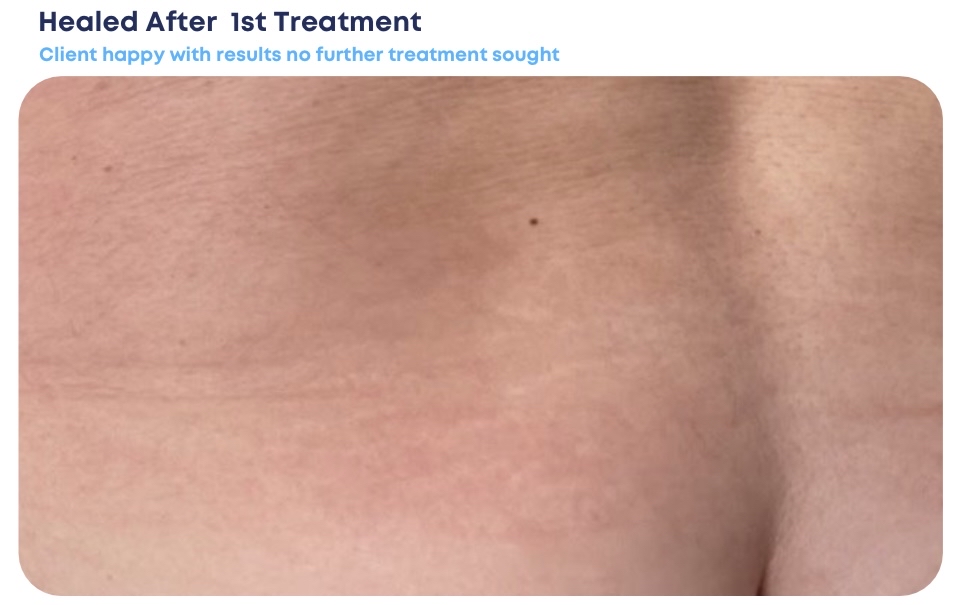 INKLESS STRETCH MARK REVISION