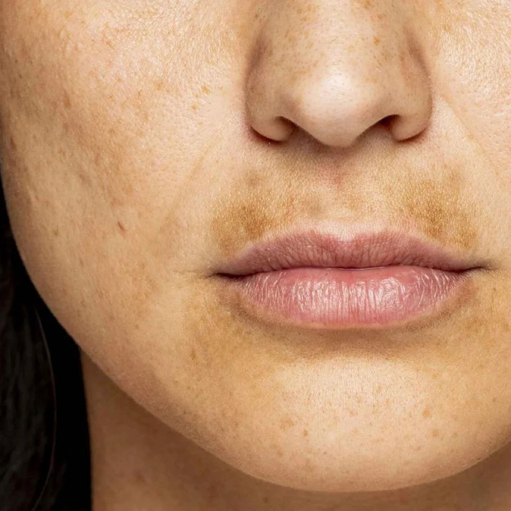 Pigment & Tone Correction at Bliss Beauty Spa in Thomaston, ME