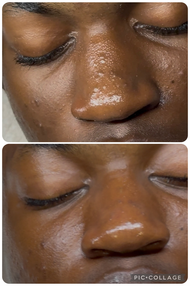 💦Bye Bye Breakouts Facial 🌿 at THE GLOW EXPERIENCE in Chicago, IL