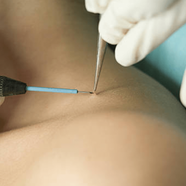Skin Tag Removal (single) at Haus of Glam by Karina J in Haverhill, FL