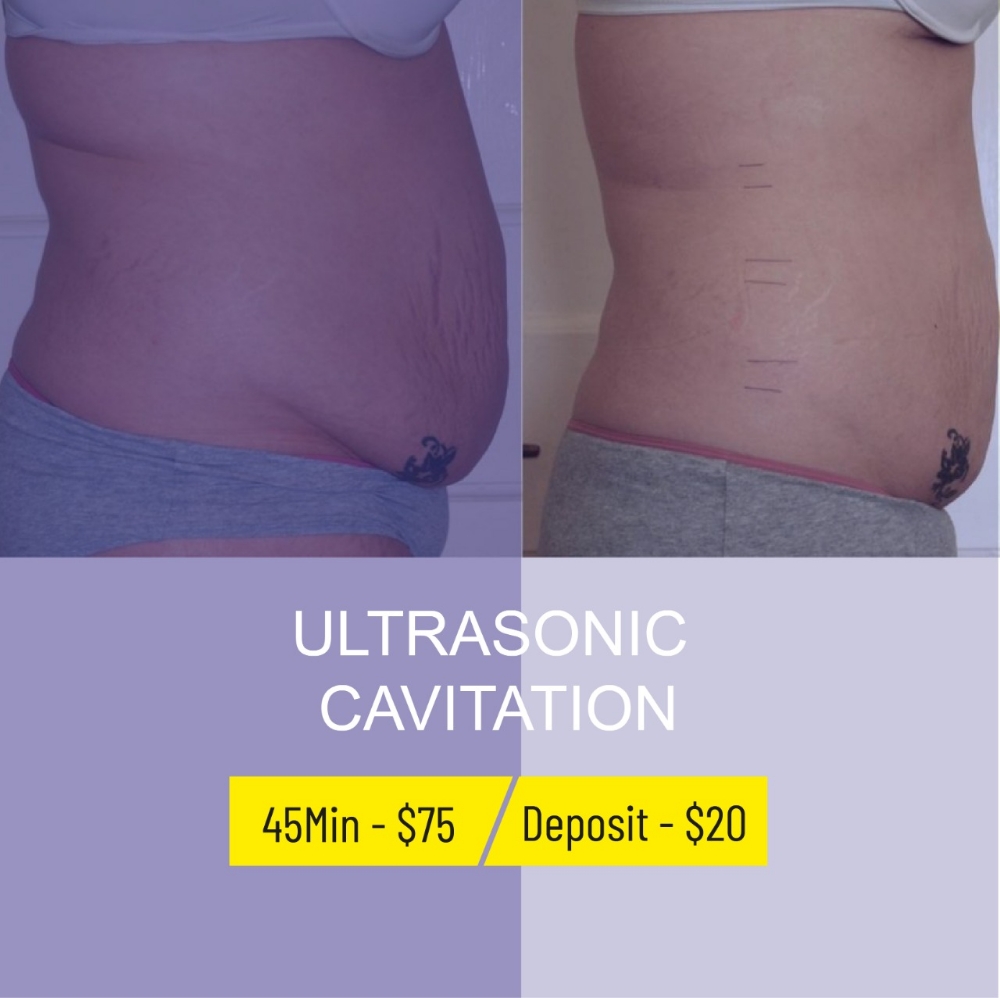 Ultrasonic Cavitation