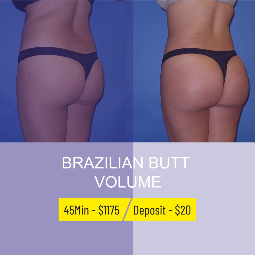 Brazilian Butt Volume