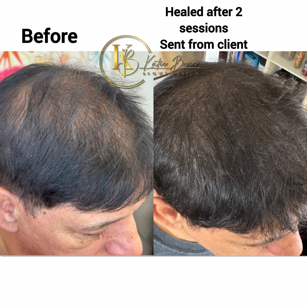 Scalp Micropigmentation 2 Sessions at Katie Brows and Cosmetic Tattoo in Monroe, CT