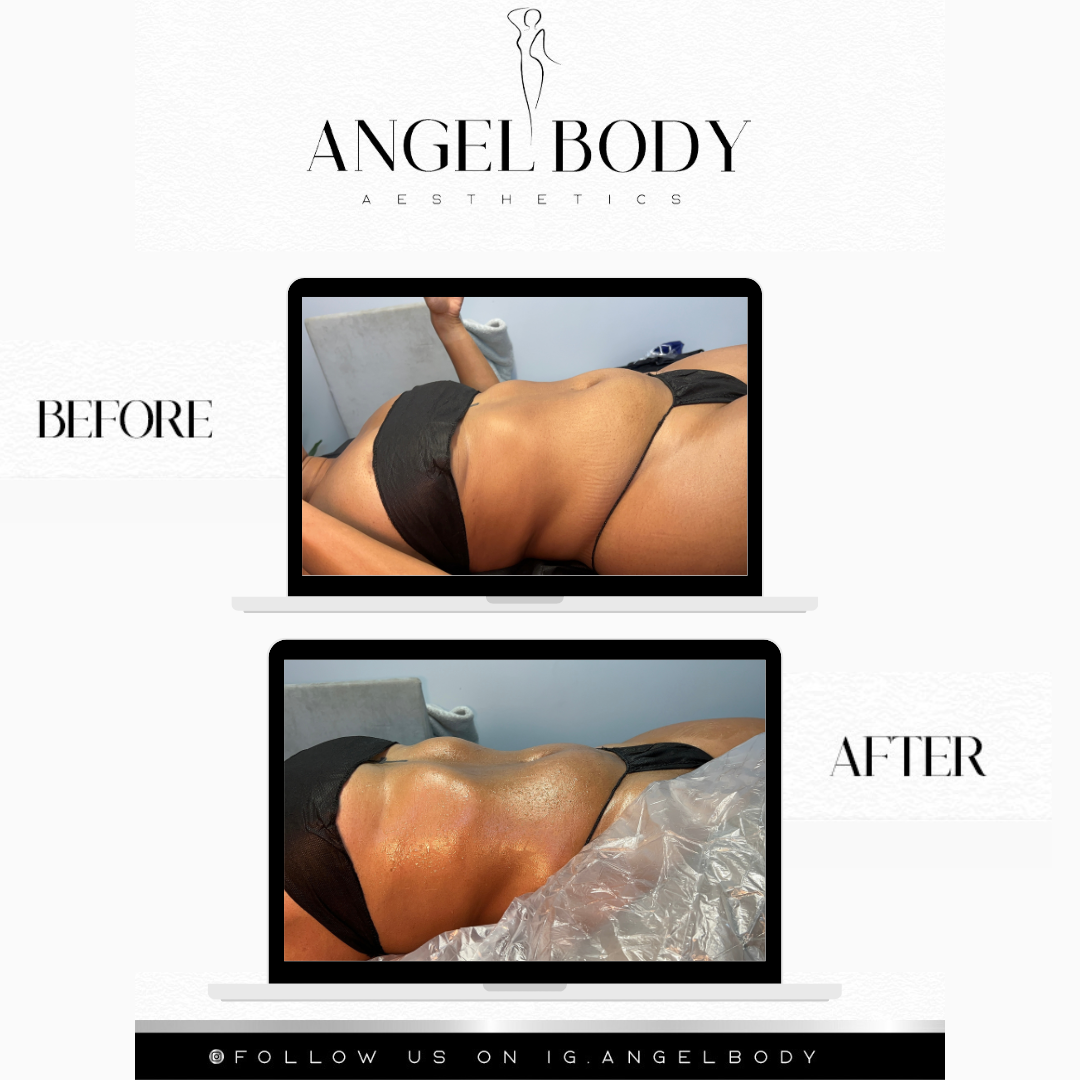 Body Sculpting at Angel Body Aesthetics in Columbia, MD