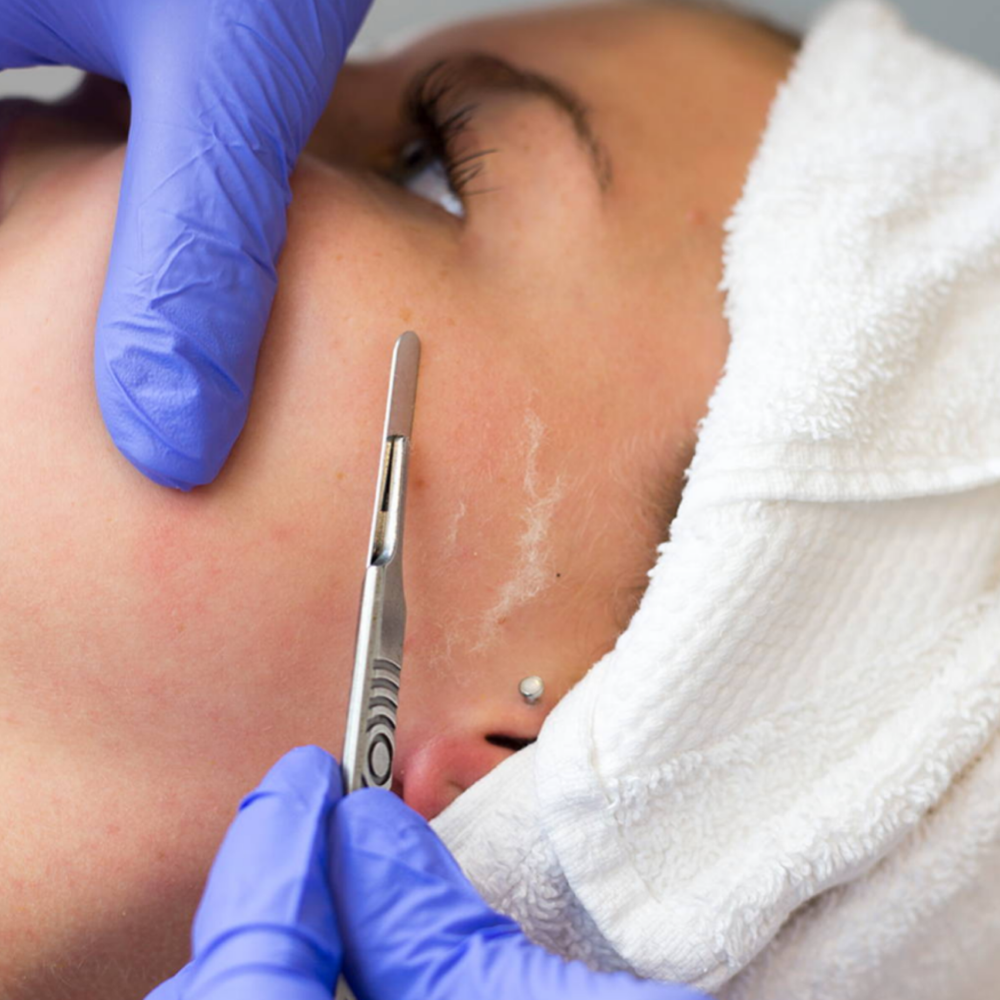 DERMAPLANING