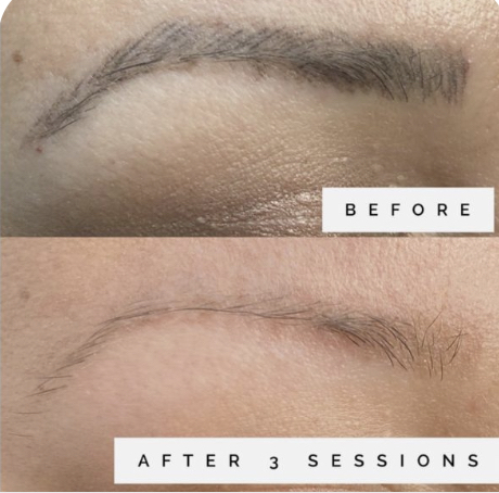 TATTOO LIGHTENING / REMOVAL