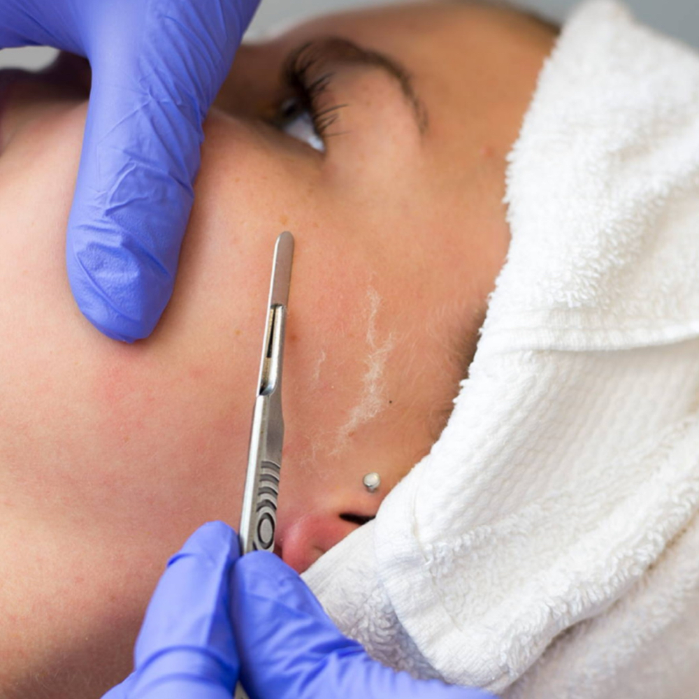 DERMAPLANING (ADD ON)