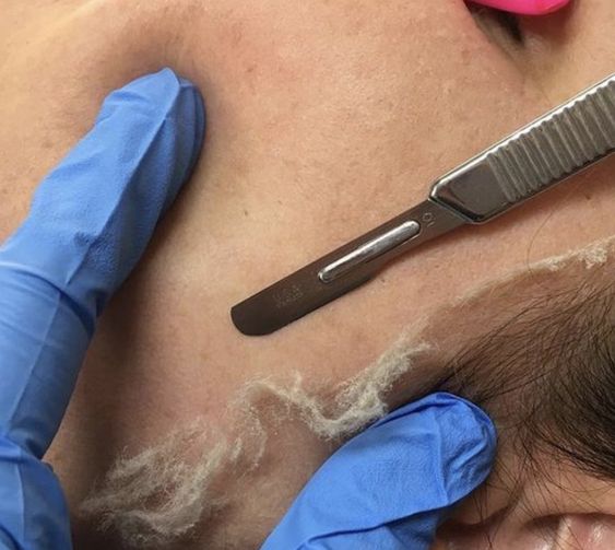 Dermaplaning