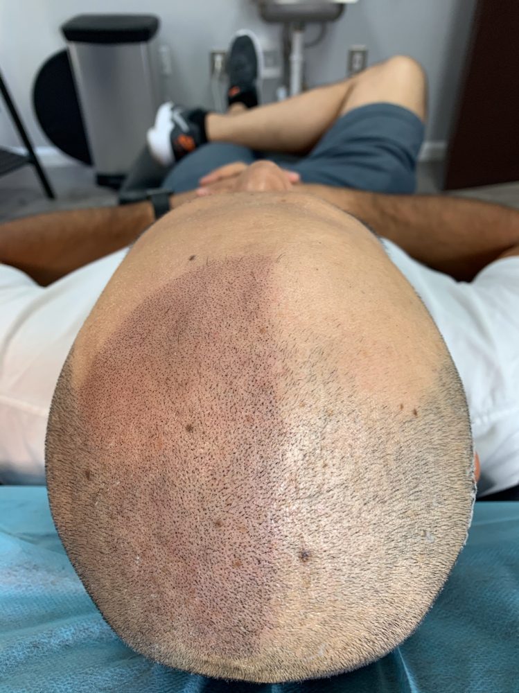 Scalp Micropigmentation