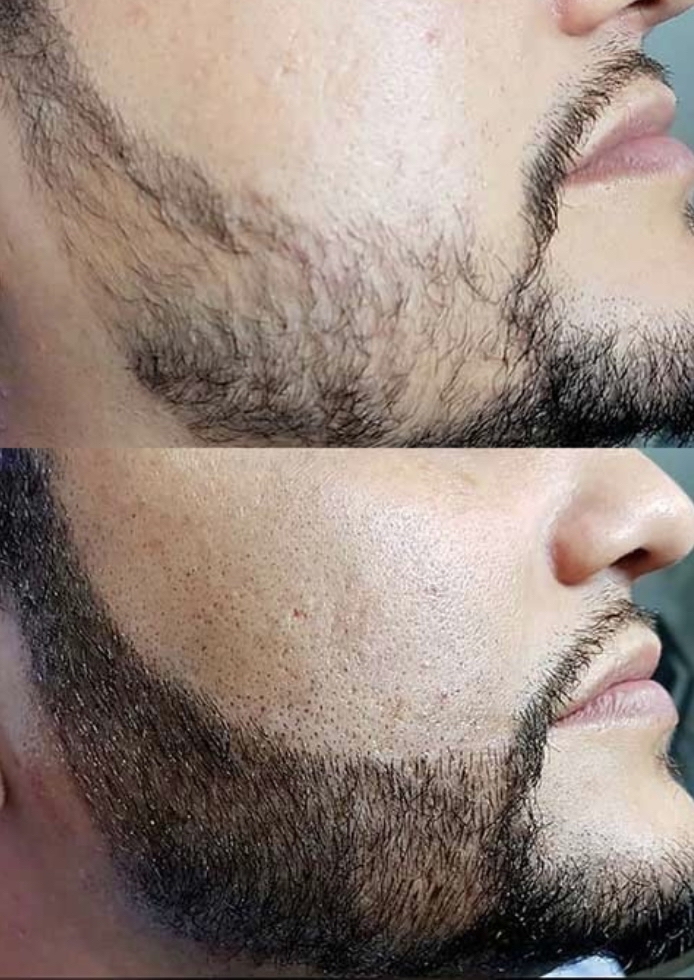 Beard Micropigmentation